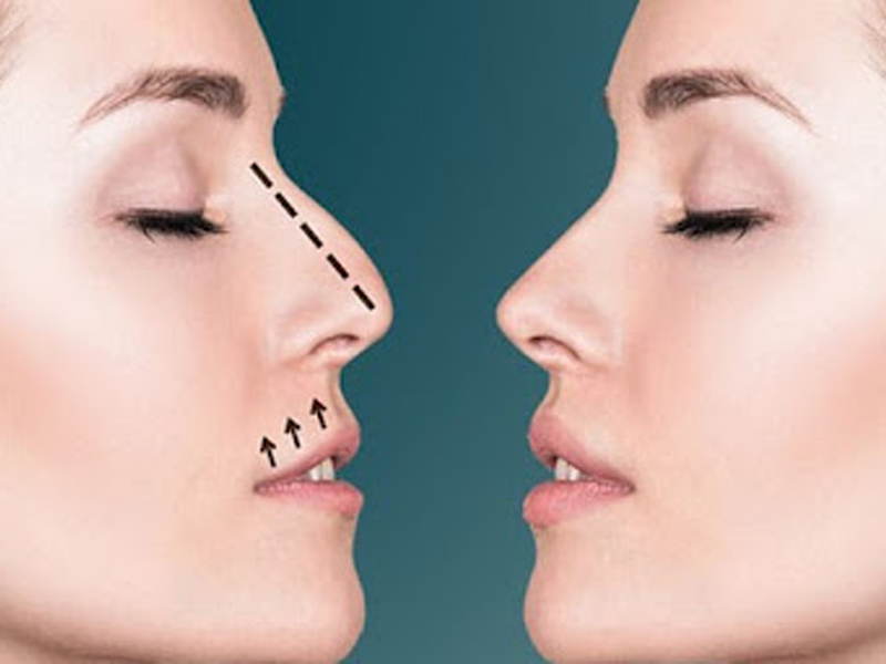 جراحی زیبایی بینی یا رینوپلاستی چیست