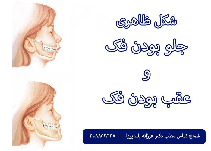 شکل ظاهری جلو بودن و عقب بودن فک