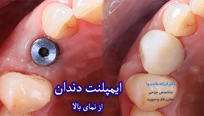 عکس ایمپلنت دندان