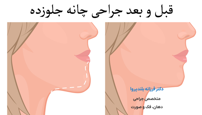 عکس قبل و بعد جراحی چانه جلوزده