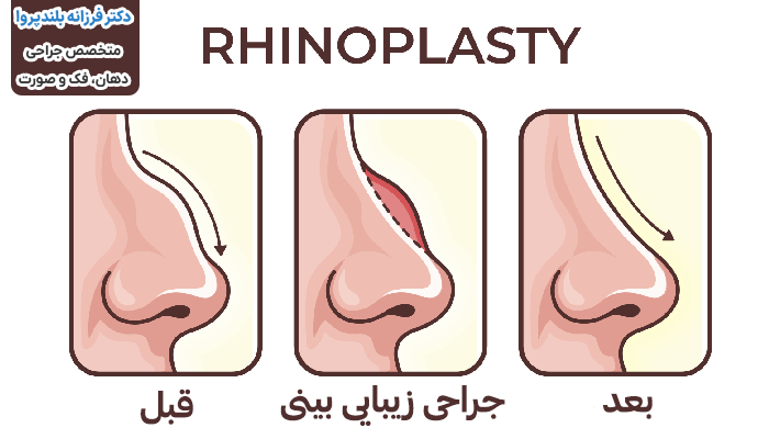 مراحل جراحی زیبایی بینی یا رینوپلاستی