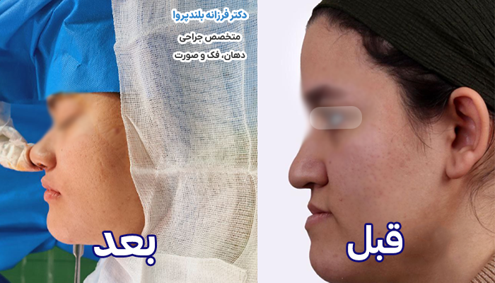 نمونه عکس قبل و بعد از عمل دو فک