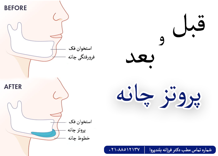 پروتز چانه از انواع جراحی های چانه
