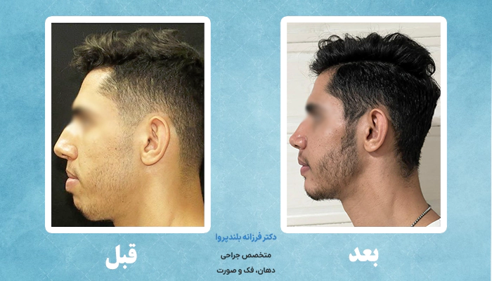 عکس قبل و بعد جراحی فک