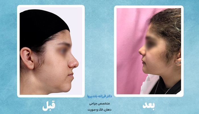 عکس نمونه کار قبل و بعد جراحی فک
