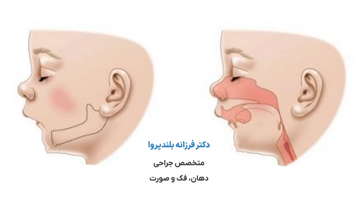 علائم ظاهری مشکلات فک در کودکان