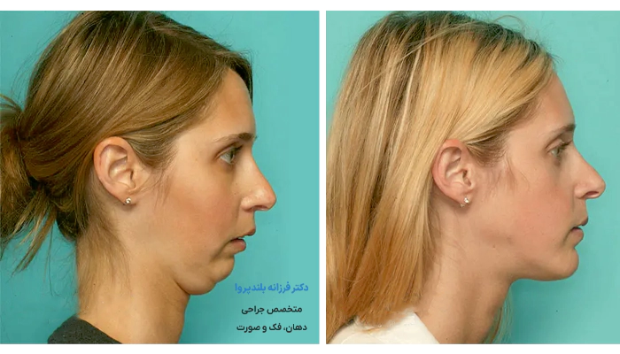 عوارض جراحی فک بدون ارتودنسی