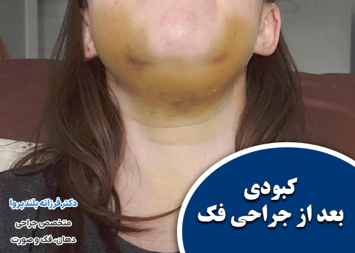 کبودی صورت بعد از جراحی فک