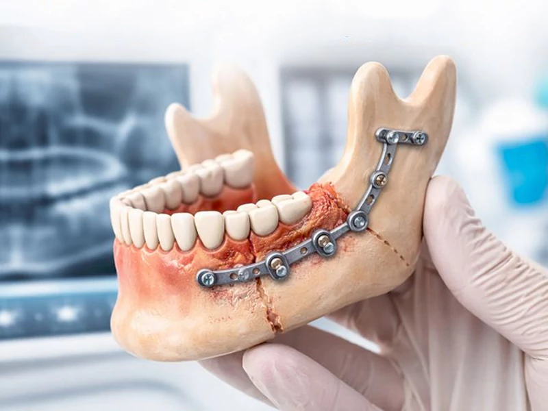 جوش خوردن فک بعد از جراحی چقدر طول میکشد؟