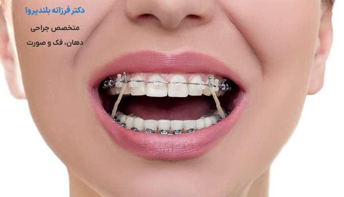 خوابیدن با کش الاستیک بعد جراحی فک