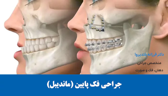 جراحی فک پایین (ماندیبل)