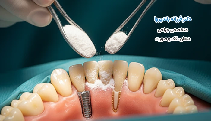 چرا قبل از ایمپلنت به پودر استخوان نیاز پیدا می‌کنیم؟
