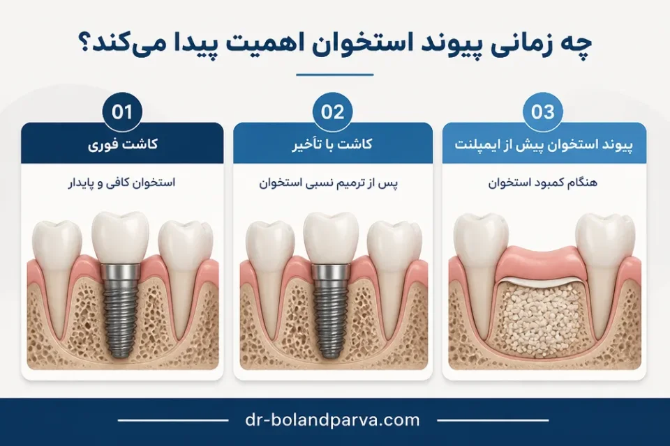 چه زمانی پیوند استخوان اهمیت پیدا میکند — مقایسه مسیرهای کاشت فوری ایمپلنت، کاشت با تأخیر و پیوند استخوان